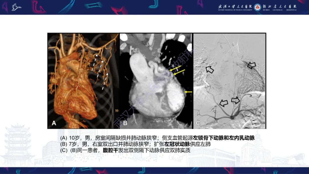 影像PPT - 【PPT】主肺动脉侧支影像诊断-11