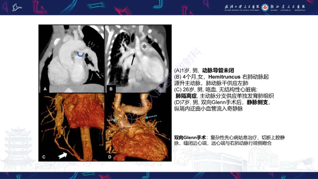 影像PPT - 【PPT】主肺动脉侧支影像诊断-21