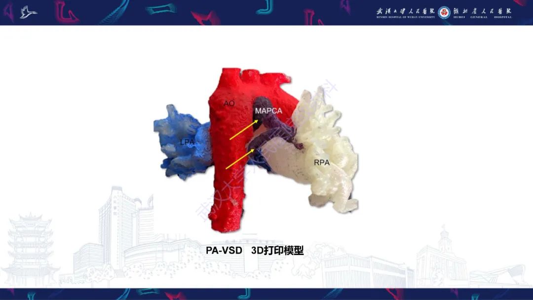 影像PPT - 【PPT】主肺动脉侧支影像诊断-15