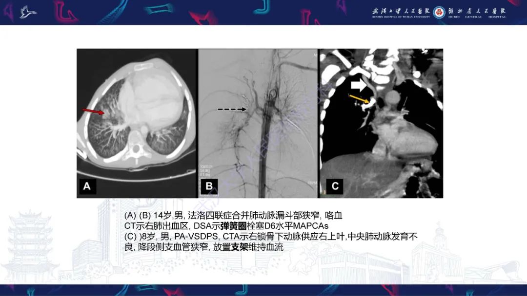 影像PPT - 【PPT】主肺动脉侧支影像诊断-23