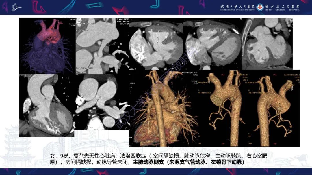 影像PPT - 【PPT】主肺动脉侧支影像诊断-2