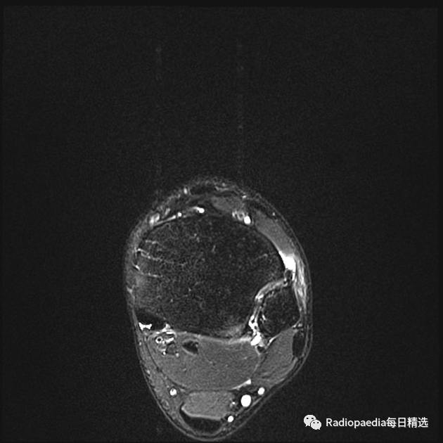 影像PPT - 【病例】下胫腓联合损伤1例影像表现-17 影像PPT - 【病例】下胫腓联合损伤1例影像表现-17