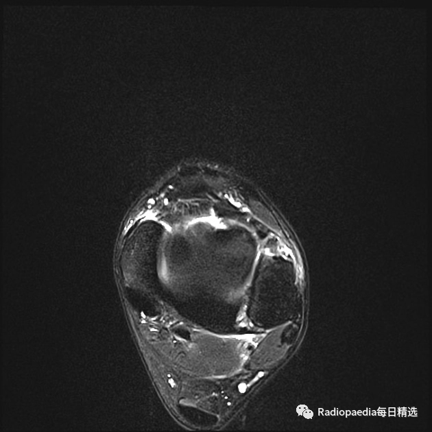 影像PPT - 【病例】下胫腓联合损伤1例影像表现-13 影像PPT - 【病例】下胫腓联合损伤1例影像表现-13