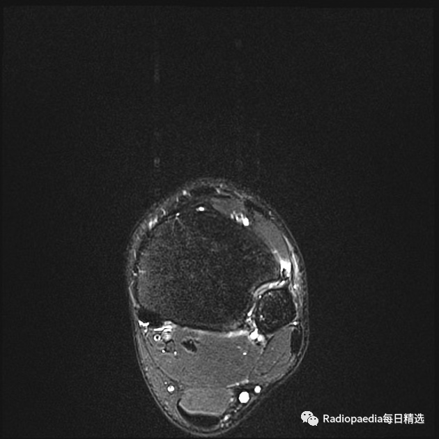 影像PPT - 【病例】下胫腓联合损伤1例影像表现-18 影像PPT - 【病例】下胫腓联合损伤1例影像表现-18