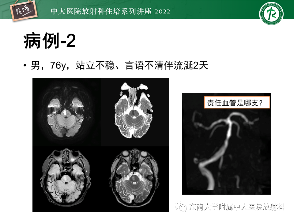 影像PPT - 【PPT】大脑后循环供血区脑梗死影像学表现-3