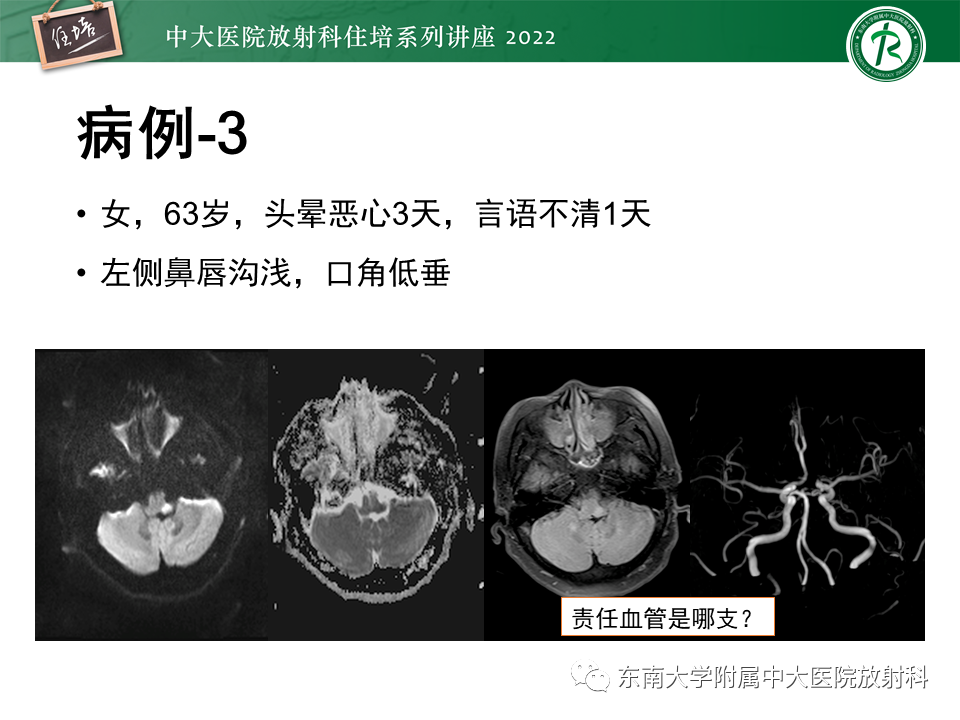 影像PPT - 【PPT】大脑后循环供血区脑梗死影像学表现-4
