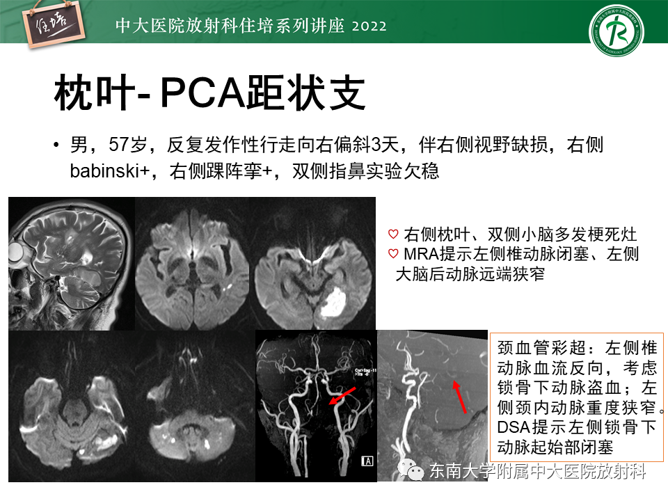 影像PPT - 【PPT】大脑后循环供血区脑梗死影像学表现-14