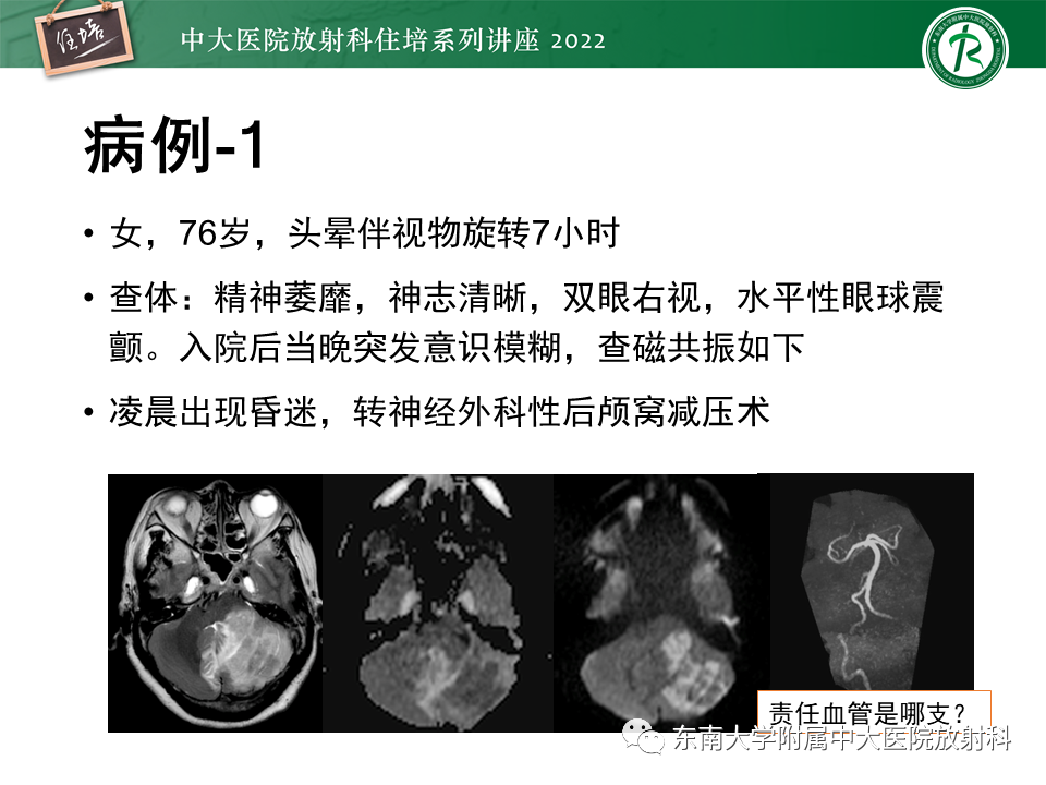 影像PPT - 【PPT】大脑后循环供血区脑梗死影像学表现-2