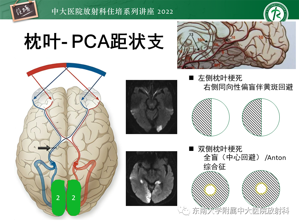 影像PPT - 【PPT】大脑后循环供血区脑梗死影像学表现-13