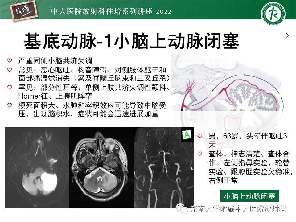 影像PPT - 【PPT】大脑后循环供血区脑梗死影像学表现-17