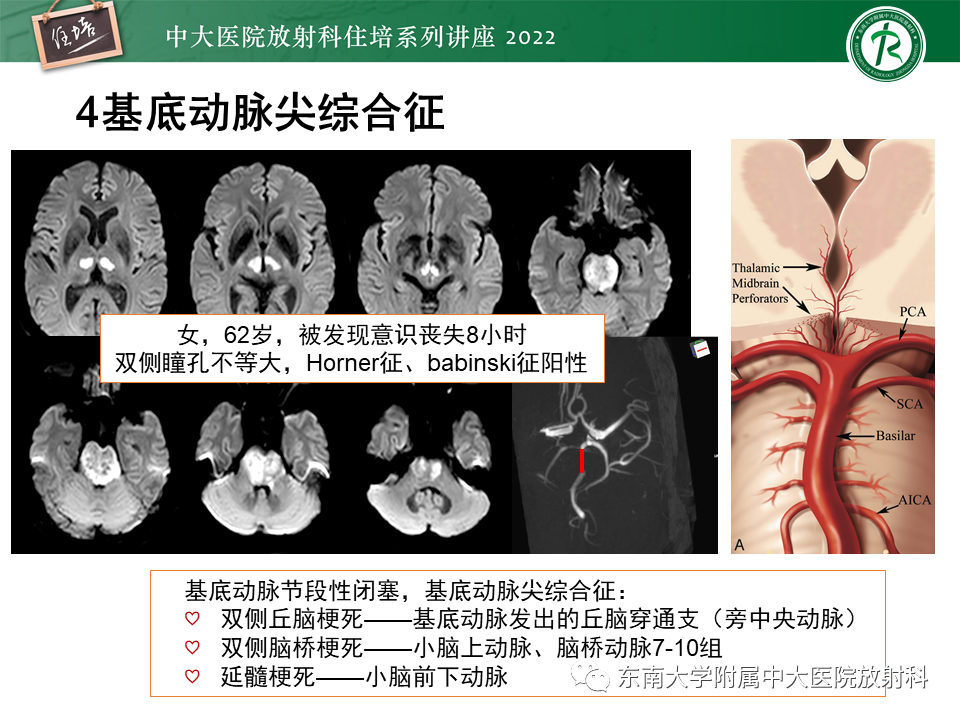 影像PPT - 【PPT】大脑后循环供血区脑梗死影像学表现-23