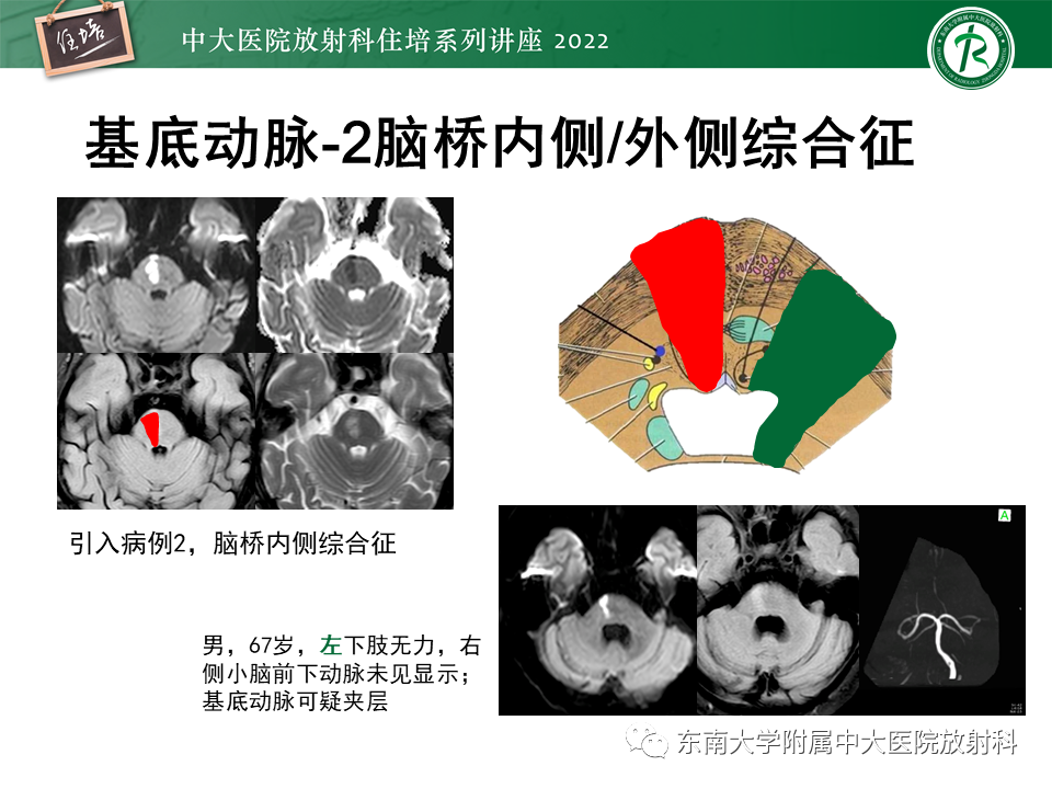 影像PPT - 【PPT】大脑后循环供血区脑梗死影像学表现-19