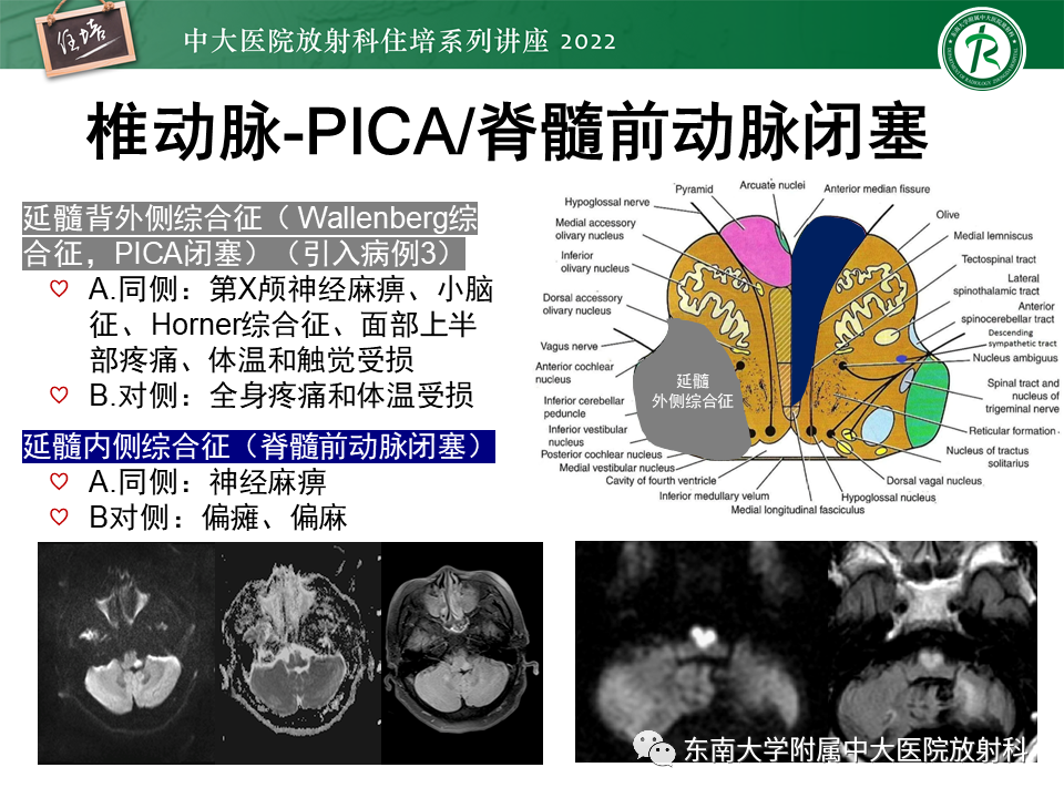 影像PPT - 【PPT】大脑后循环供血区脑梗死影像学表现-29