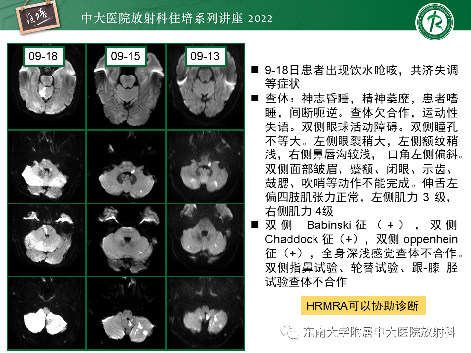 影像PPT - 【PPT】大脑后循环供血区脑梗死影像学表现-31