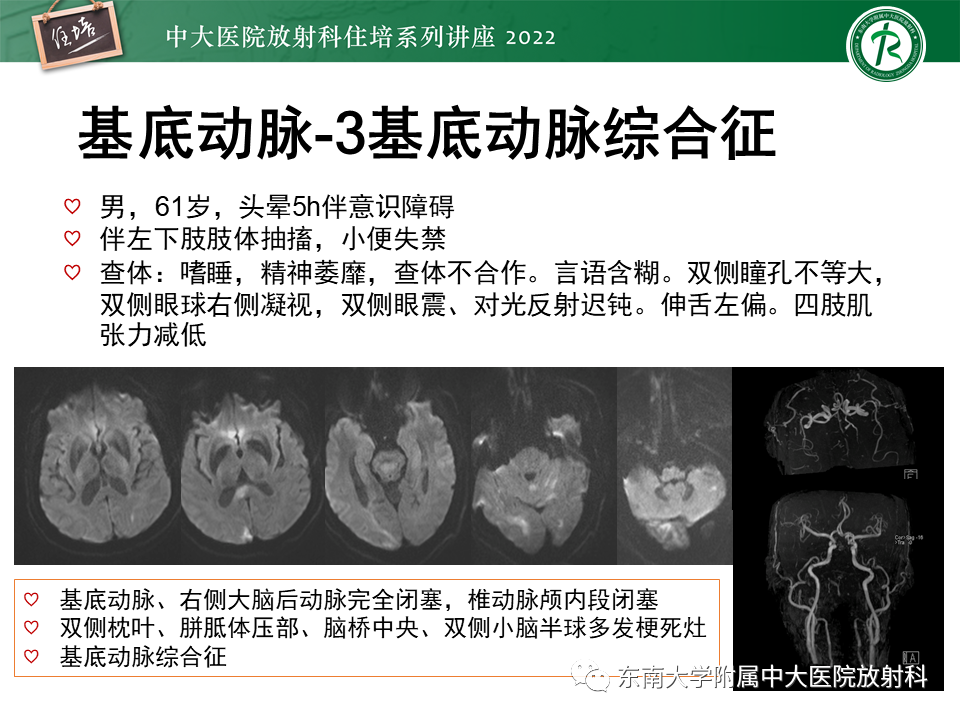 影像PPT - 【PPT】大脑后循环供血区脑梗死影像学表现-21