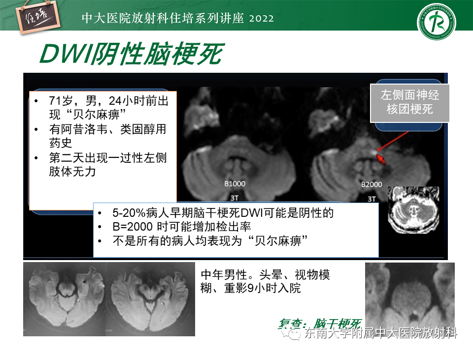 影像PPT - 【PPT】大脑后循环供血区脑梗死影像学表现-24