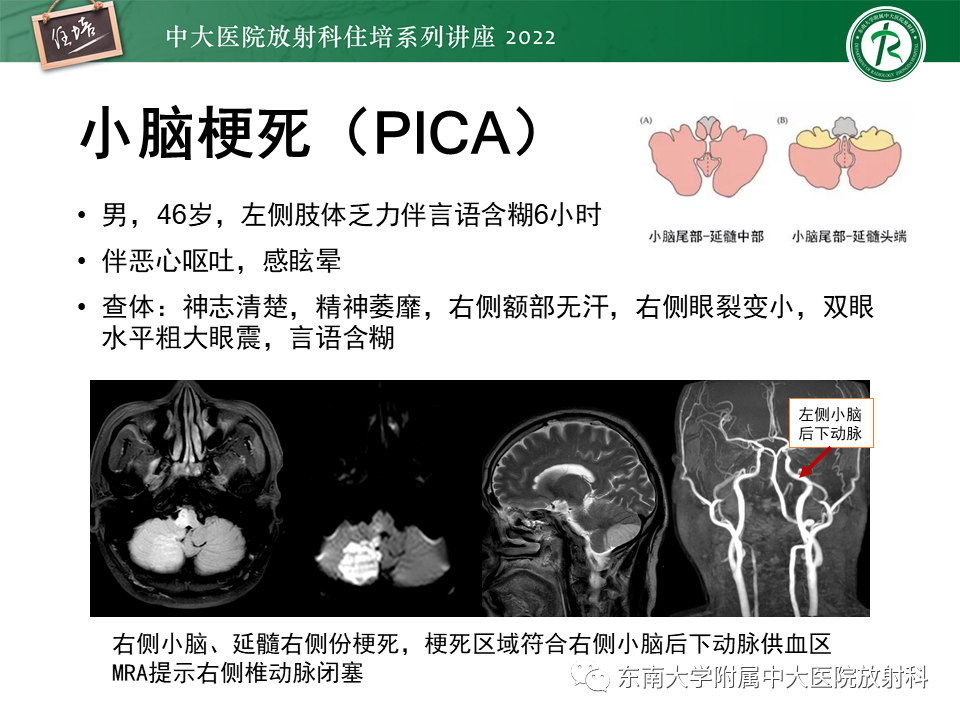 影像PPT - 【PPT】大脑后循环供血区脑梗死影像学表现-28