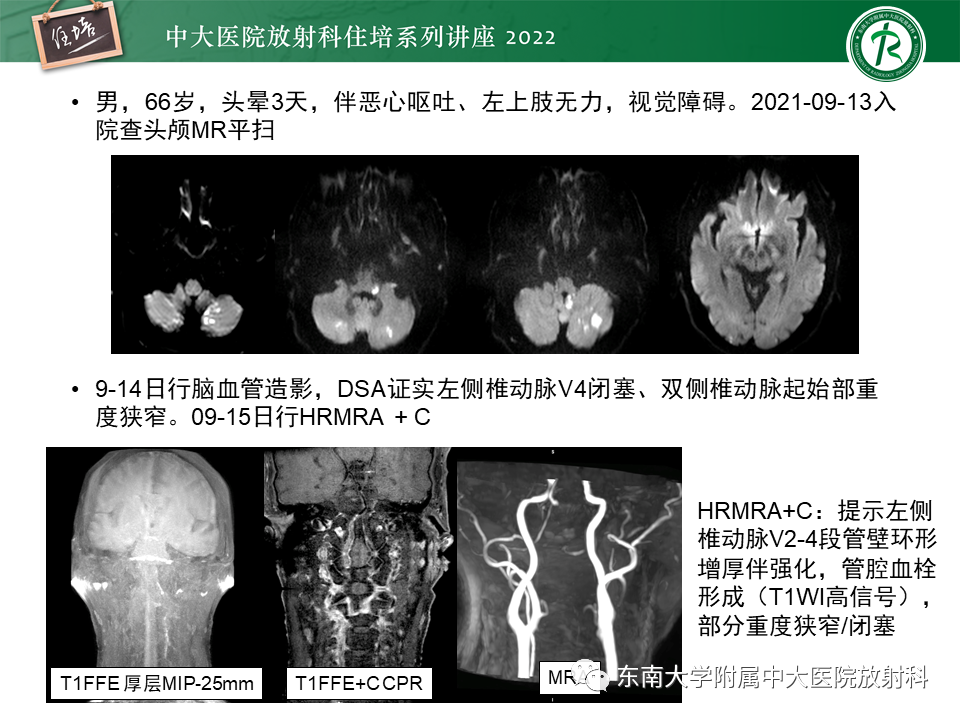 影像PPT - 【PPT】大脑后循环供血区脑梗死影像学表现-30