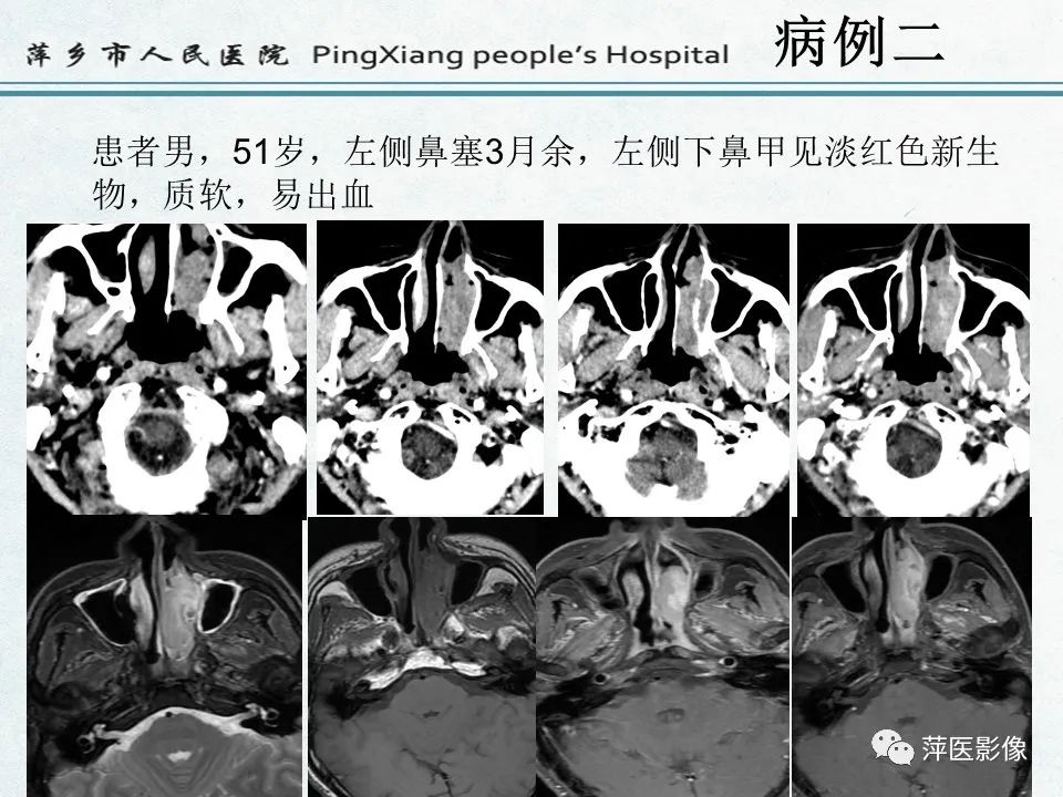 影像PPT - 【PPT】鼻咽部肿瘤影像学上的异同-3