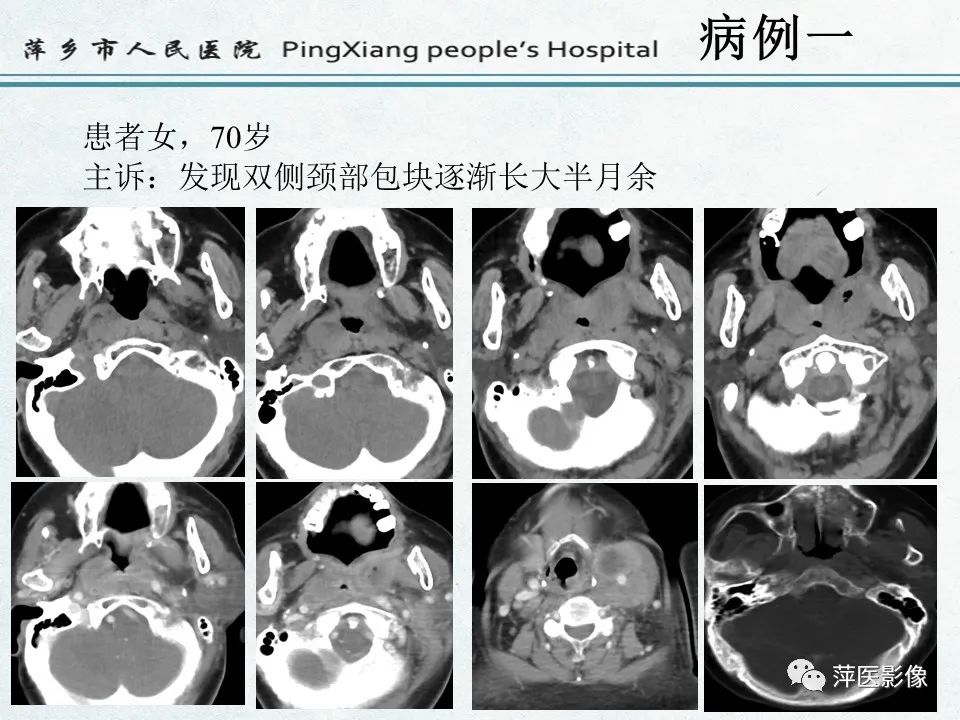 影像PPT - 【PPT】鼻咽部肿瘤影像学上的异同-2