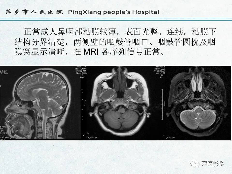 影像PPT - 【PPT】鼻咽部肿瘤影像学上的异同-6