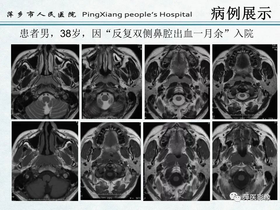 影像PPT - 【PPT】鼻咽部肿瘤影像学上的异同-10