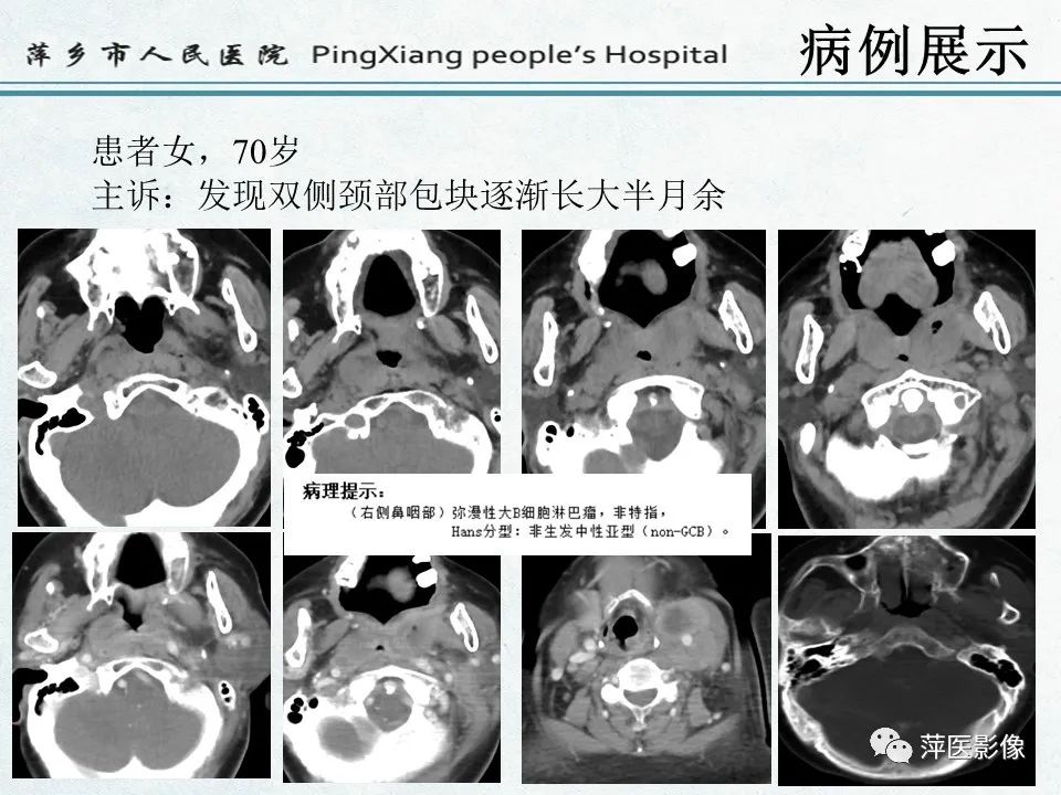 影像PPT - 【PPT】鼻咽部肿瘤影像学上的异同-9