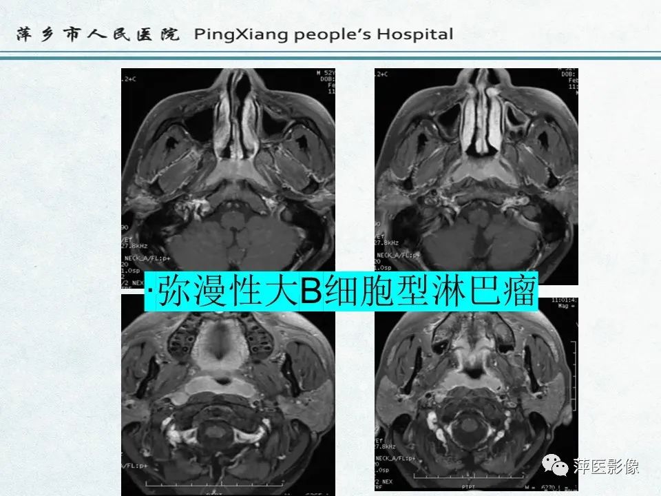 影像PPT - 【PPT】鼻咽部肿瘤影像学上的异同-11