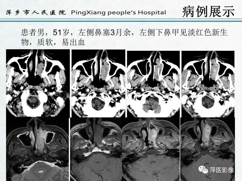 影像PPT - 【PPT】鼻咽部肿瘤影像学上的异同-15