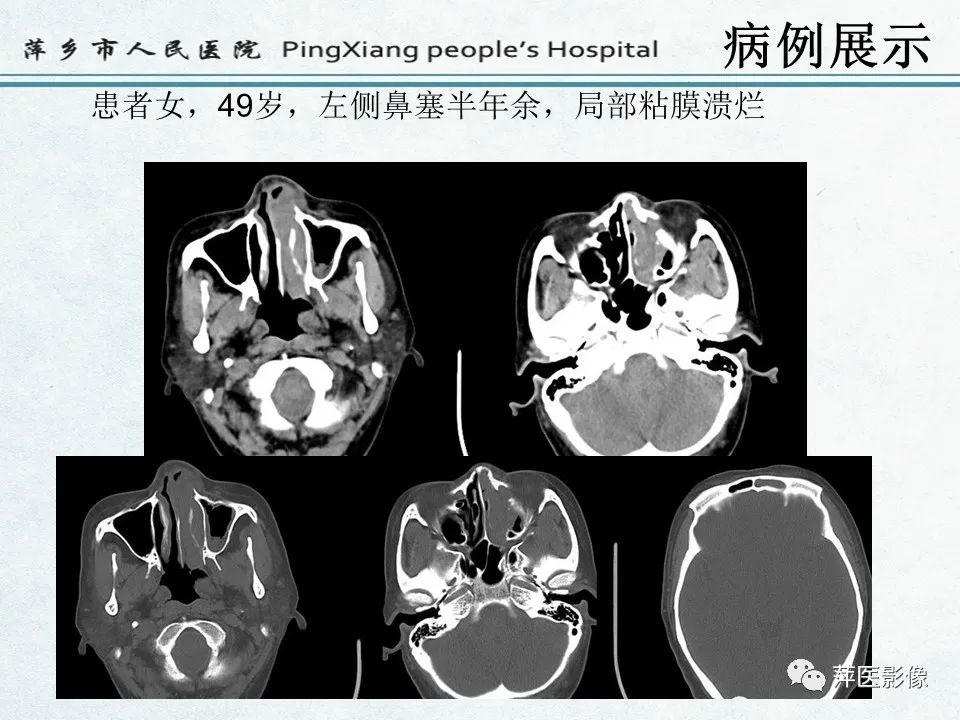 影像PPT - 【PPT】鼻咽部肿瘤影像学上的异同-16