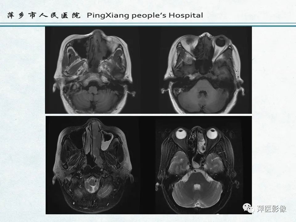 影像PPT - 【PPT】鼻咽部肿瘤影像学上的异同-17