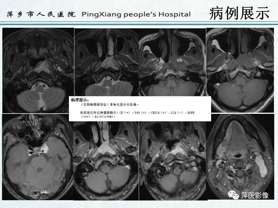 影像PPT - 【PPT】鼻咽部肿瘤影像学上的异同-24