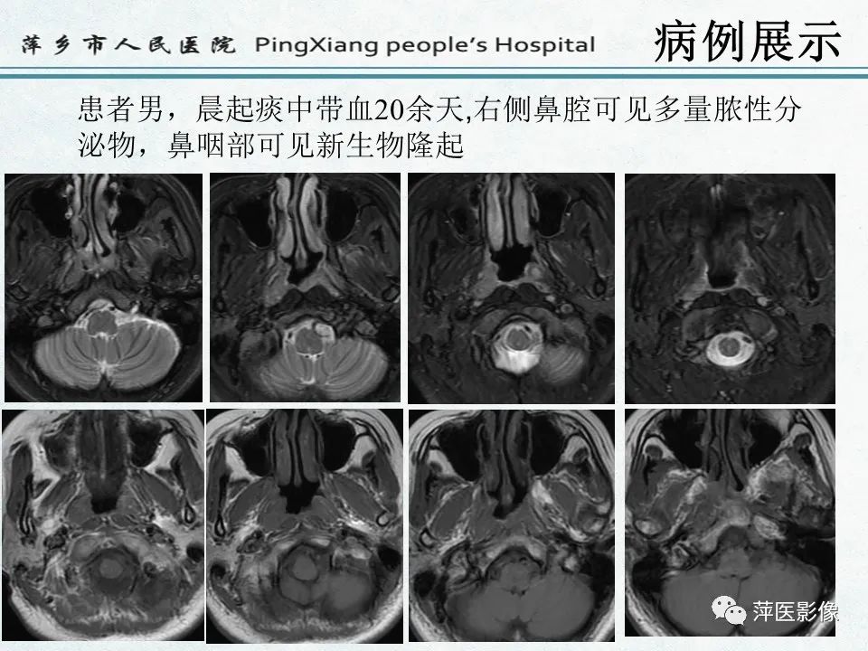 影像PPT - 【PPT】鼻咽部肿瘤影像学上的异同-25