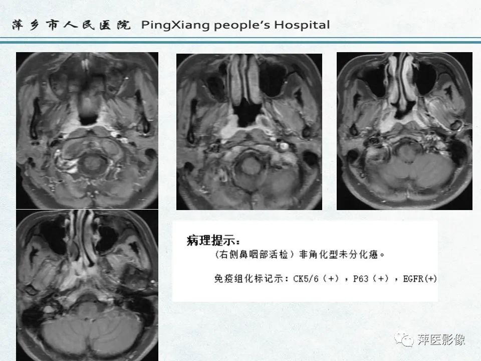 影像PPT - 【PPT】鼻咽部肿瘤影像学上的异同-26
