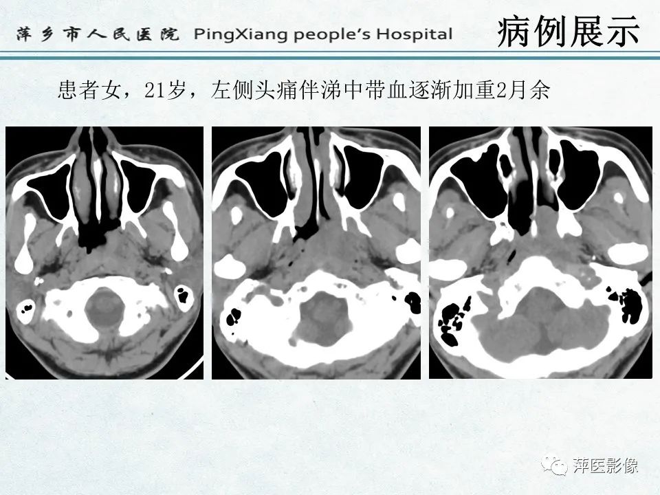 影像PPT - 【PPT】鼻咽部肿瘤影像学上的异同-23