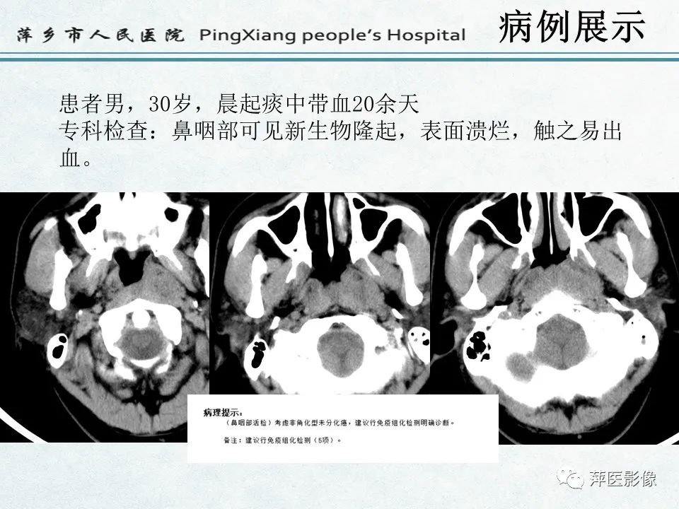 影像PPT - 【PPT】鼻咽部肿瘤影像学上的异同-27