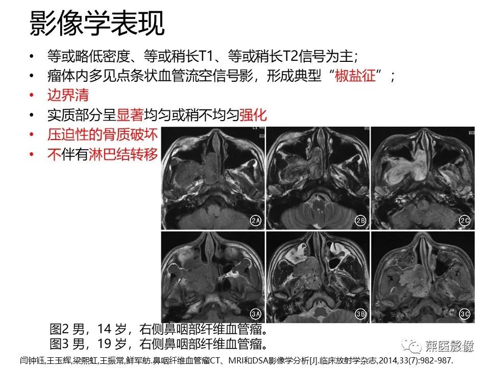 影像PPT - 【PPT】鼻咽部肿瘤影像学上的异同-33