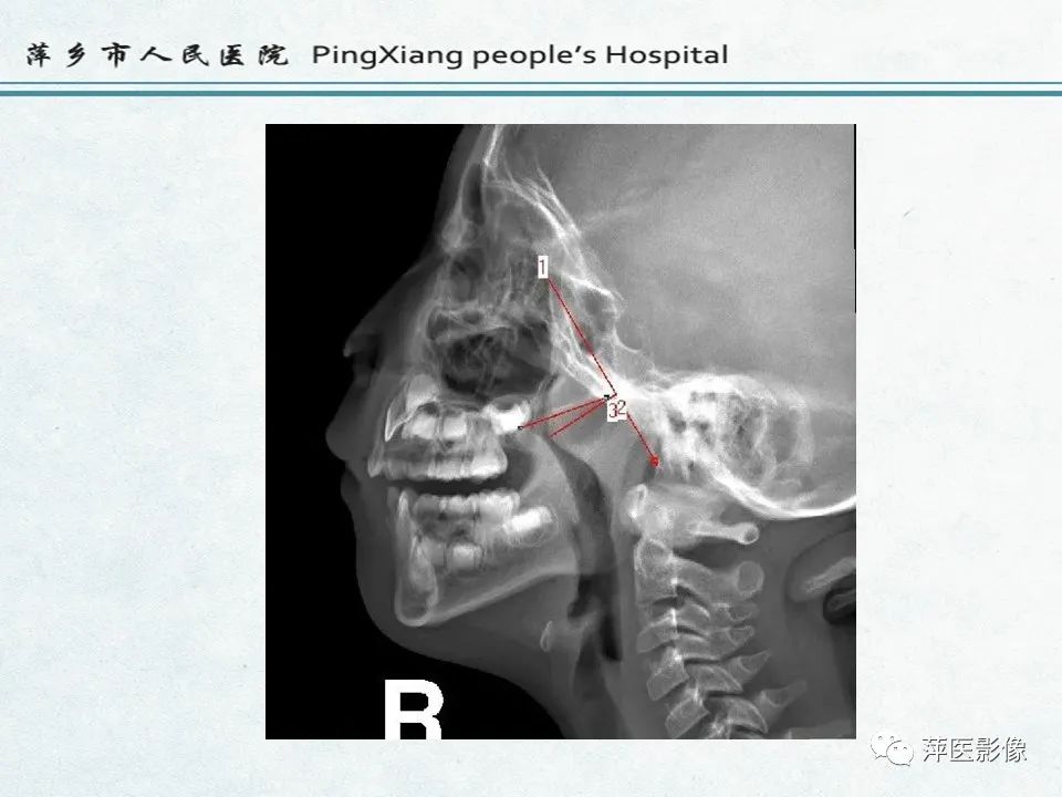 影像PPT - 【PPT】鼻咽部肿瘤影像学上的异同-38