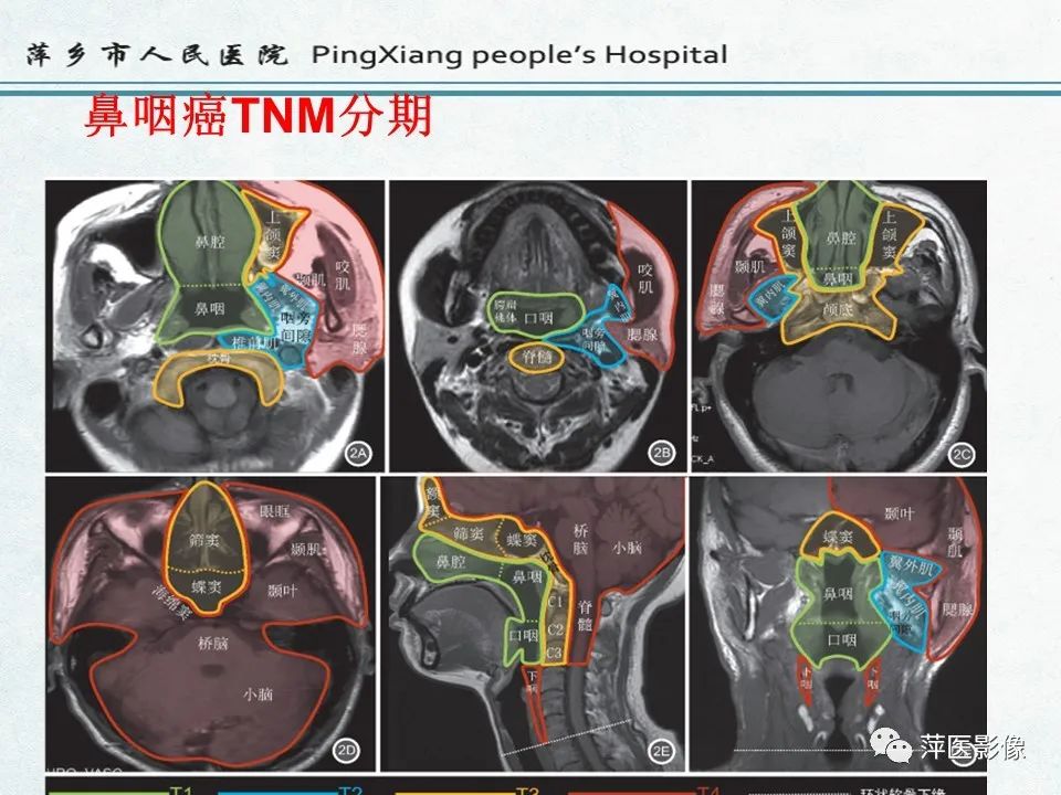 影像PPT - 【PPT】鼻咽部肿瘤影像学上的异同-29