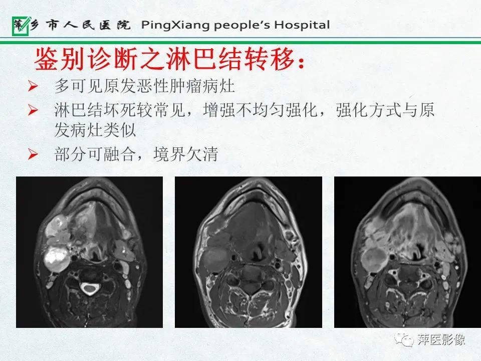 影像PPT - 【PPT】鼻咽部肿瘤影像学上的异同-39