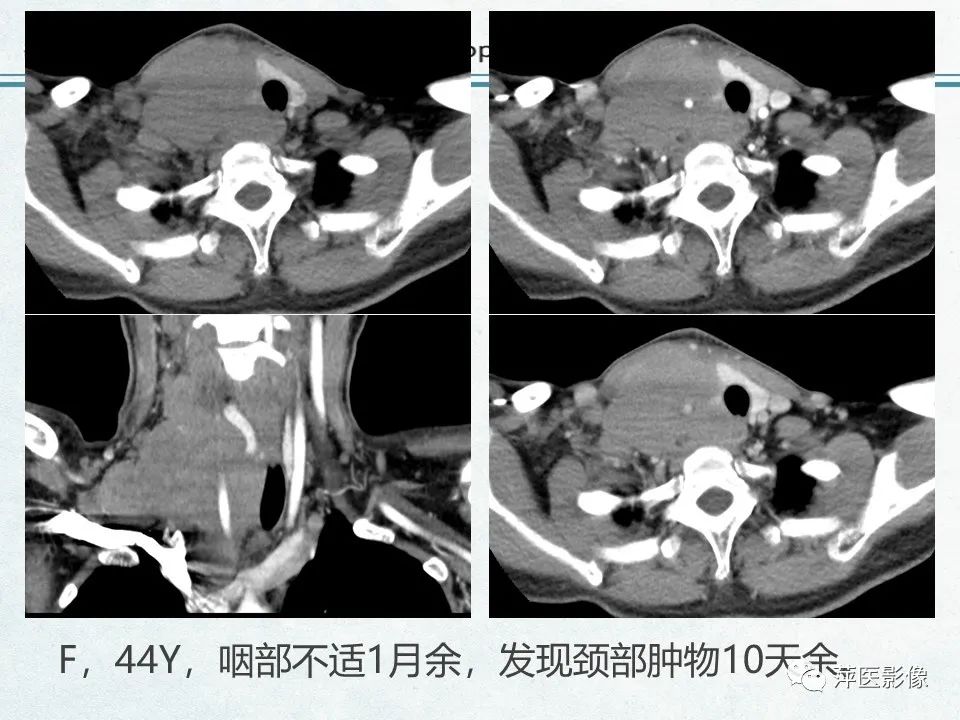 影像PPT - 【PPT】鼻咽部肿瘤影像学上的异同-45
