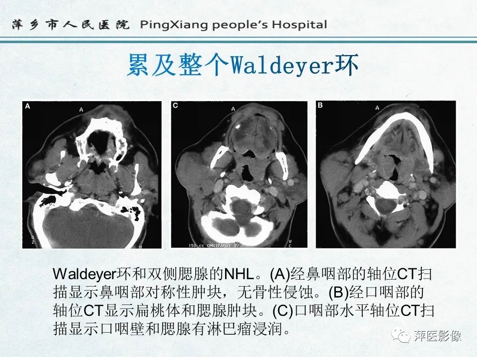 影像PPT - 【PPT】鼻咽部肿瘤影像学上的异同-48