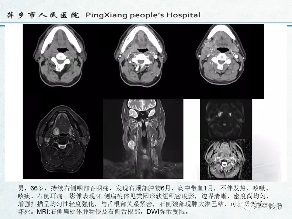 影像PPT - 【PPT】鼻咽部肿瘤影像学上的异同-35