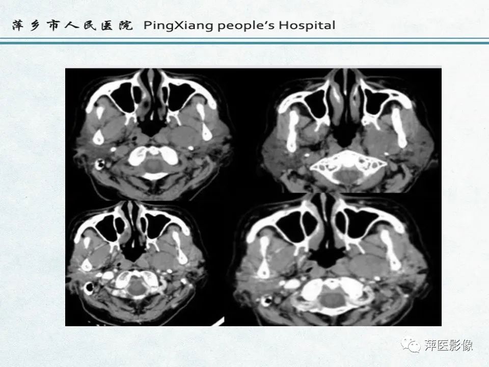 影像PPT - 【PPT】鼻咽部肿瘤影像学上的异同-43