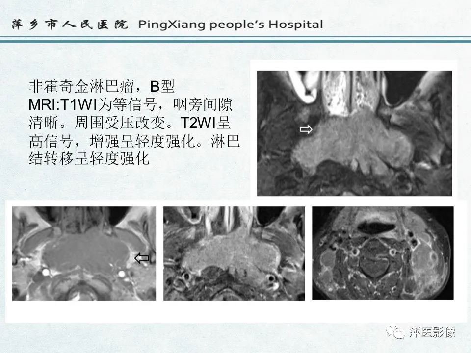 影像PPT - 【PPT】鼻咽部肿瘤影像学上的异同-49
