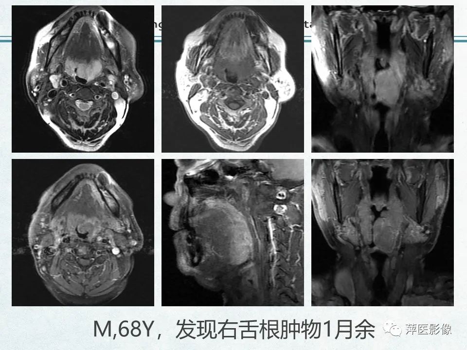 影像PPT - 【PPT】鼻咽部肿瘤影像学上的异同-47