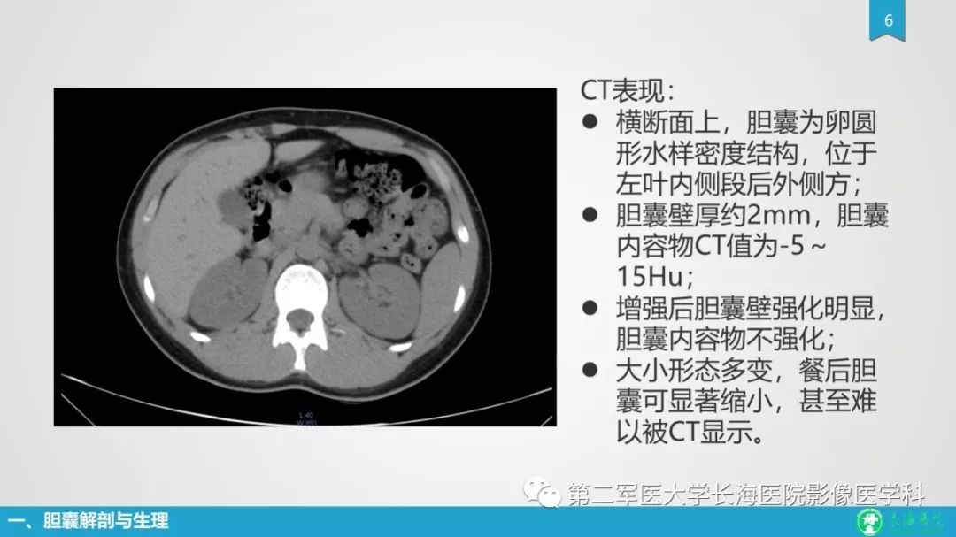 影像PPT - 【PPT】胆囊良性病变及其影像学特征-6