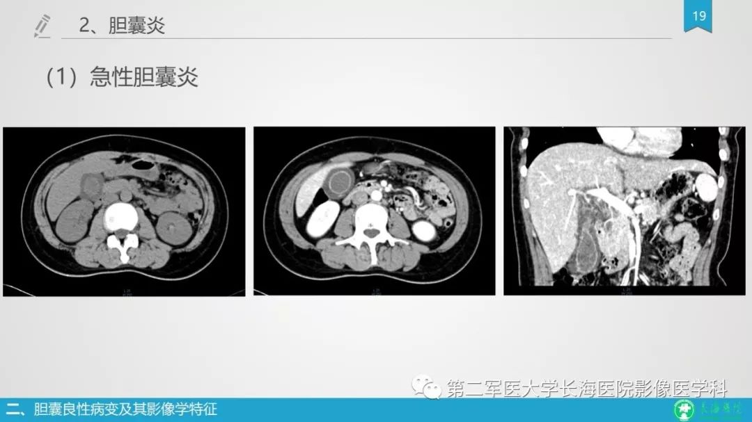 影像PPT - 【PPT】胆囊良性病变及其影像学特征-19