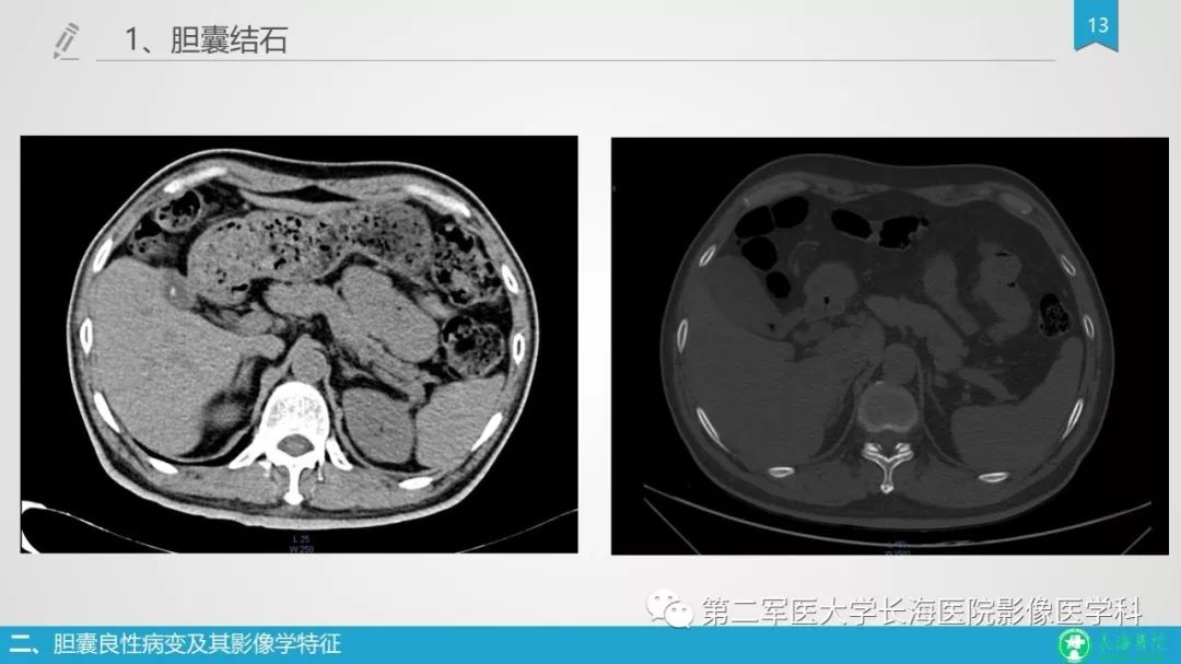 影像PPT - 【PPT】胆囊良性病变及其影像学特征-13