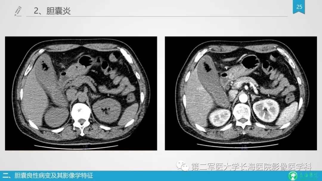 影像PPT - 【PPT】胆囊良性病变及其影像学特征-24